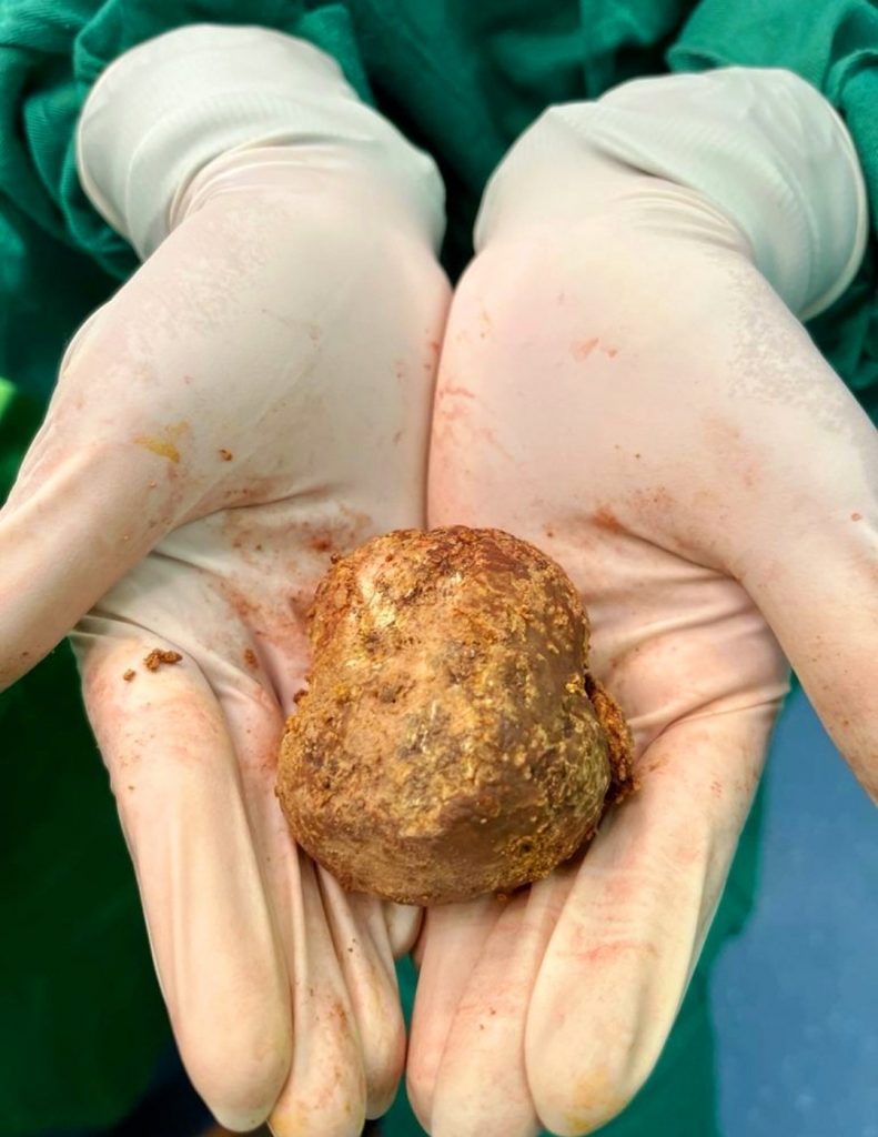 சிறுநீரகத்திலிருத்து எடுக்கப்பட்ட பாரிய கல்