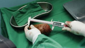 பெரிய சிறுநீரகக் கல்லை அகற்றி இலங்கை ராணுவம் சாதனை!