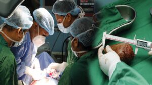 பெரிய சிறுநீரகக் கல்லை அகற்றி இலங்கை ராணுவம் சாதனை!